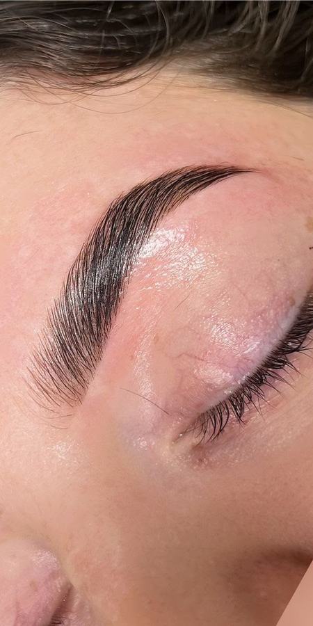Brow Lifting – nachher