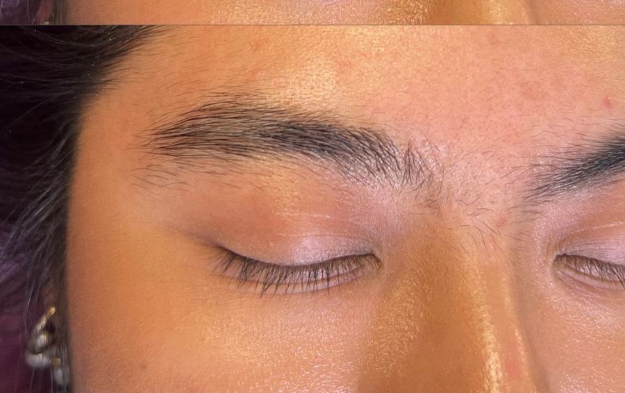 Brow Lifting – vorher